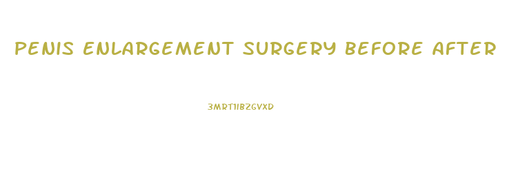 Penis Enlargement Surgery Before After
