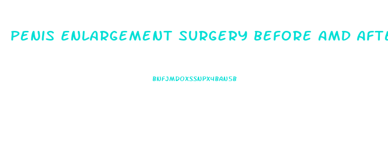Penis Enlargement Surgery Before Amd After