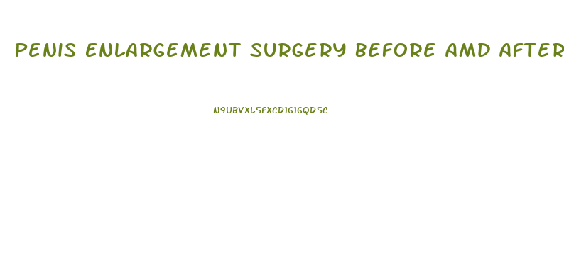 Penis Enlargement Surgery Before Amd After