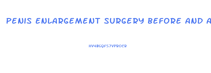 Penis Enlargement Surgery Before And Adter