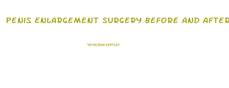 Penis Enlargement Surgery Before And After Pics