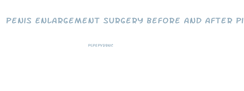 Penis Enlargement Surgery Before And After Pictures