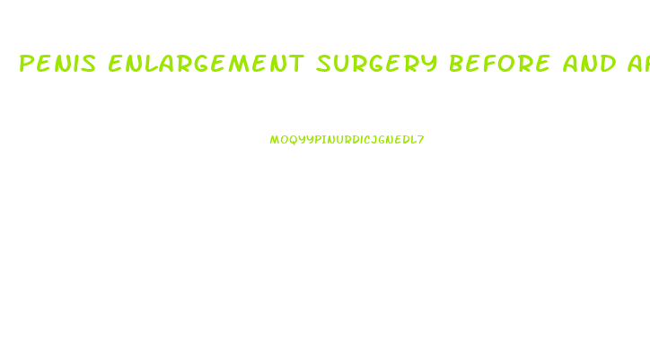 Penis Enlargement Surgery Before And After When Hard