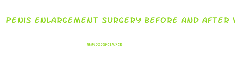 Penis Enlargement Surgery Before And After When Hard