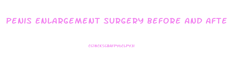 Penis Enlargement Surgery Before And After With Erection
