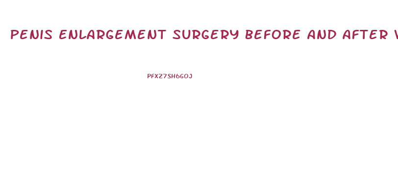 Penis Enlargement Surgery Before And After With Erection