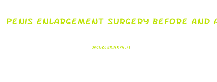 Penis Enlargement Surgery Before And Aftrt