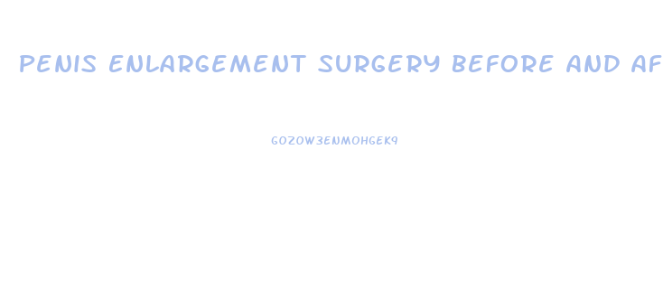 Penis Enlargement Surgery Before And Afyer