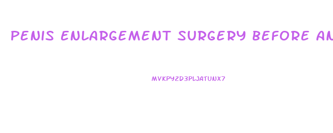 Penis Enlargement Surgery Before And Afyer Results