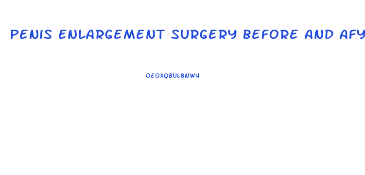 Penis Enlargement Surgery Before And Afyer Results