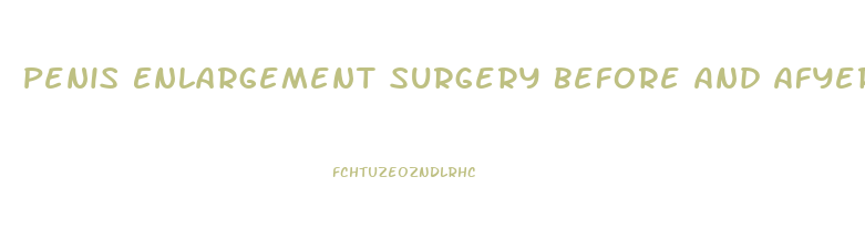 Penis Enlargement Surgery Before And Afyer