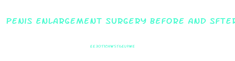 Penis Enlargement Surgery Before And Sfter