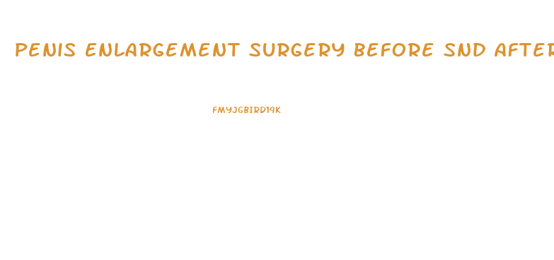 Penis Enlargement Surgery Before Snd After