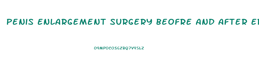 Penis Enlargement Surgery Beofre And After Erict