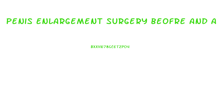 Penis Enlargement Surgery Beofre And After Erict