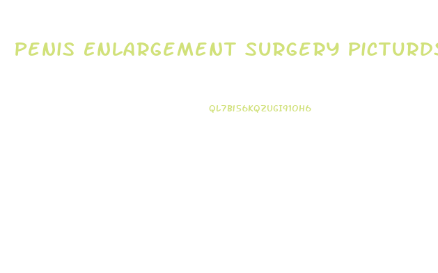 Penis Enlargement Surgery Picturds