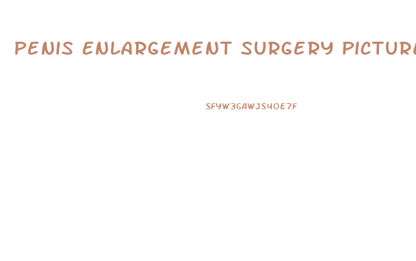 Penis Enlargement Surgery Picture