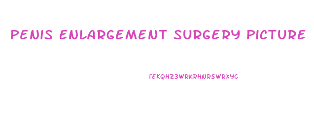 Penis Enlargement Surgery Picture