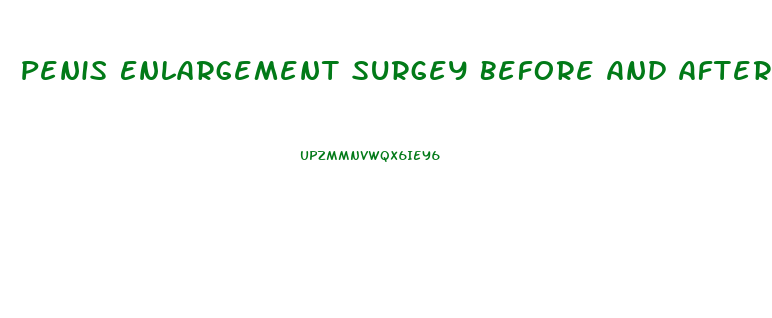 Penis Enlargement Surgey Before And After