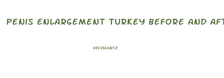 Penis Enlargement Turkey Before And After
