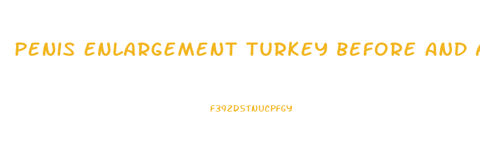 Penis Enlargement Turkey Before And After
