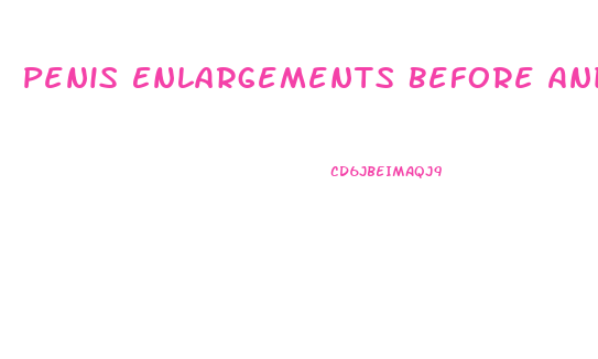 Penis Enlargements Before And After