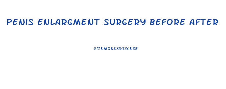 Penis Enlargment Surgery Before After