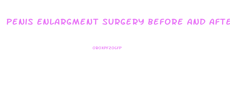 Penis Enlargment Surgery Before And After