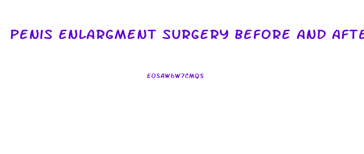 Penis Enlargment Surgery Before And After