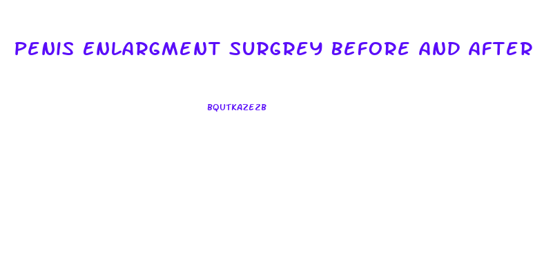 Penis Enlargment Surgrey Before And After
