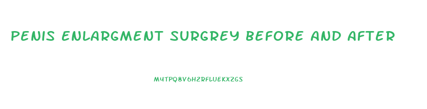 Penis Enlargment Surgrey Before And After