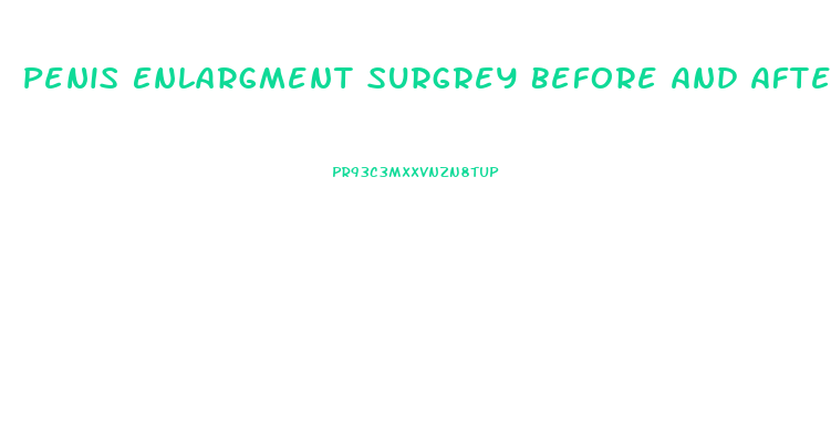 Penis Enlargment Surgrey Before And After