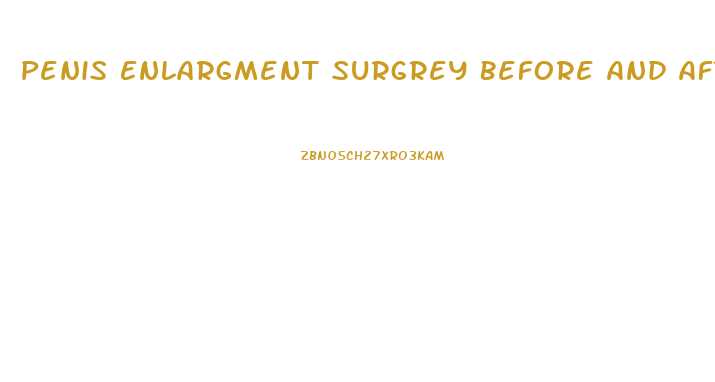 Penis Enlargment Surgrey Before And After