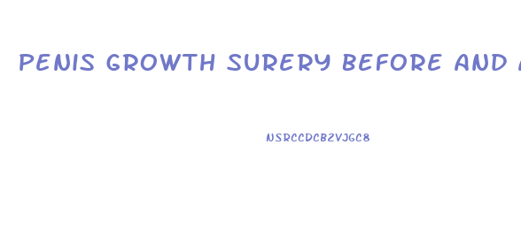 Penis Growth Surery Before And After