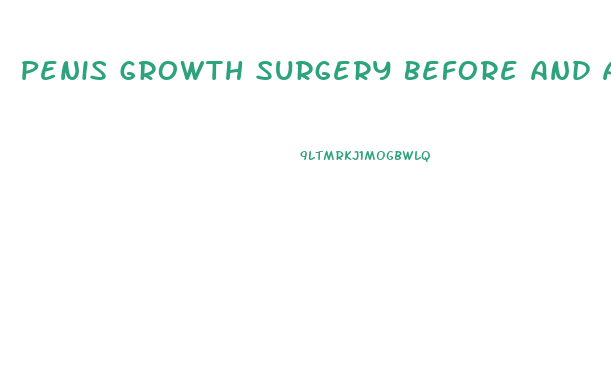 Penis Growth Surgery Before And After