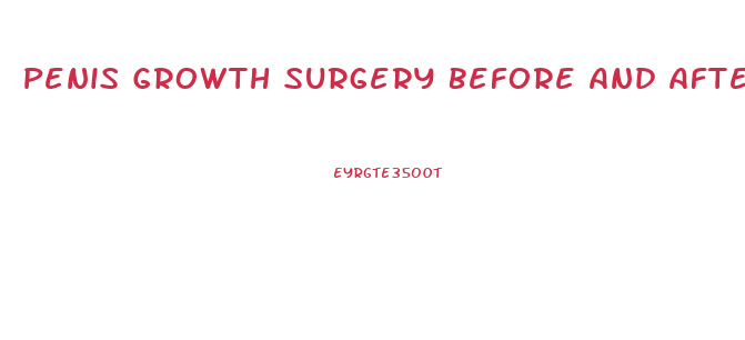 Penis Growth Surgery Before And After