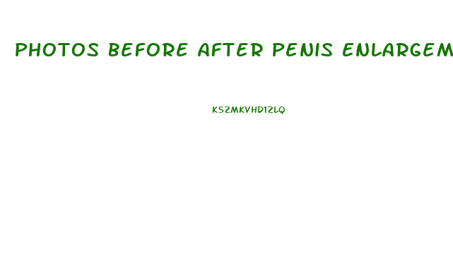 Photos Before After Penis Enlargement