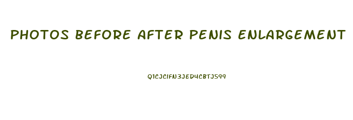 Photos Before After Penis Enlargement