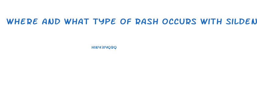 Where And What Type Of Rash Occurs With Sildenafil
