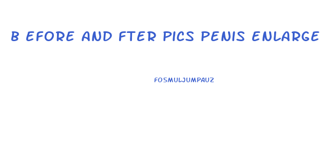 b efore and fter pics penis enlarge surgery