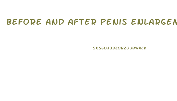 before and after penis enlargement injection