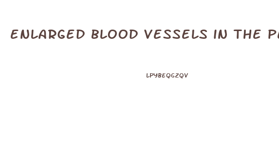enlarged blood vessels in the penis from too pumping