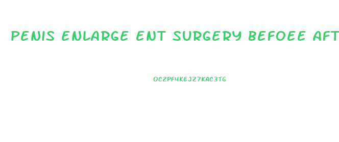 penis enlarge ent surgery befoee after