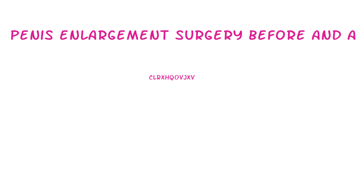 penis enlargement surgery before and aftrt