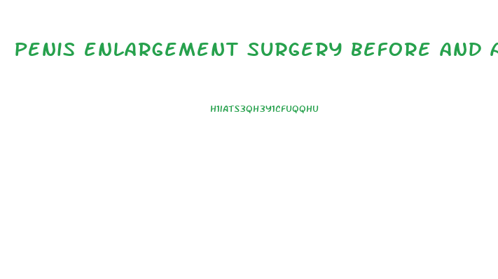 penis enlargement surgery before and afyer