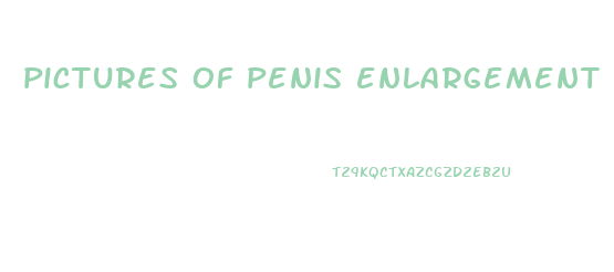pictures of penis enlargement surgery