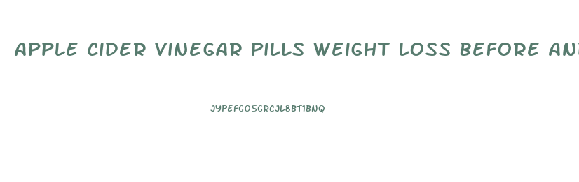 Apple Cider Vinegar Pills Weight Loss Before And After