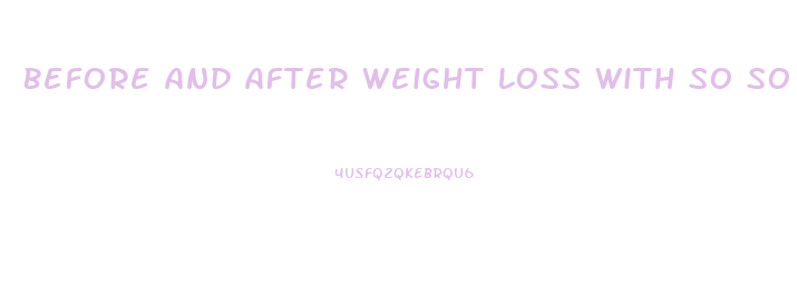 Before And After Weight Loss With So So Diet