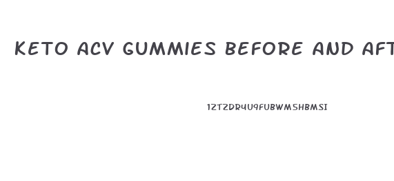 Keto Acv Gummies Before And After