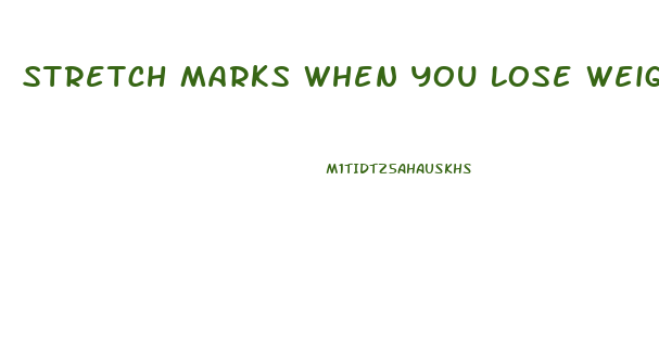 Stretch Marks When You Lose Weight